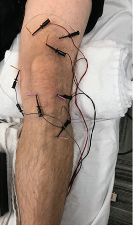 Dry Needling: What’s The Point?