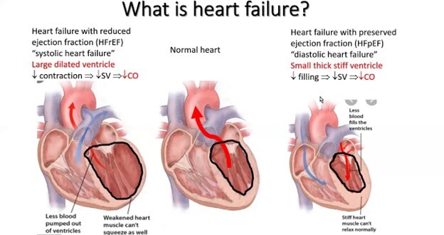 Combating Heart Failure: The Role of HIIT in Rehabilitation