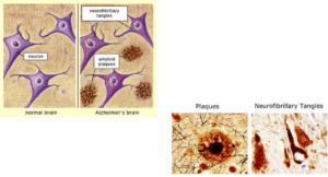 Caring for Those with Alzheimer’s Disease: Tips for Rehab Professionals and Caregivers
